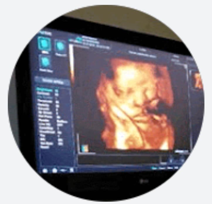 Detailed 3D ultrasound scan of a fetus's face and hand displayed on a medical monitor.